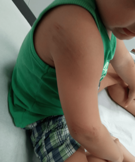 Imagen de la heridas que sufrió el menor atropellado / TA